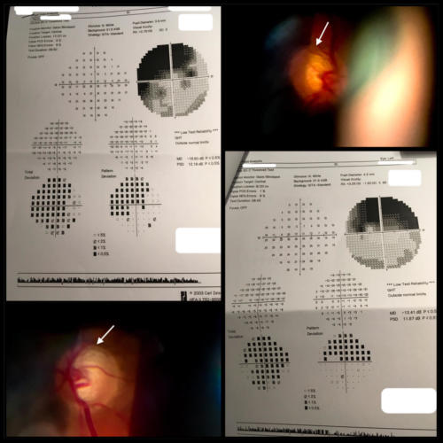 Glaucoma - optic nerve discs and perimetry